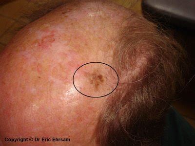 melanoma in situ of scalp